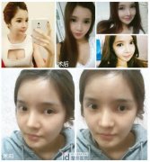 女人360度无死角-告别突出高颧骨