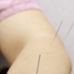 解读针灸解痛原理与效果