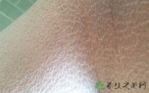 冬天为什么腿干燥
